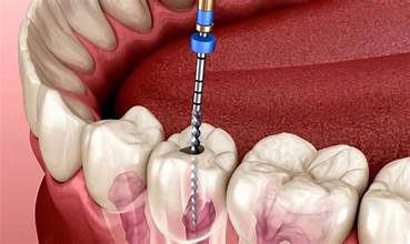 Root Canal Thumbnail
